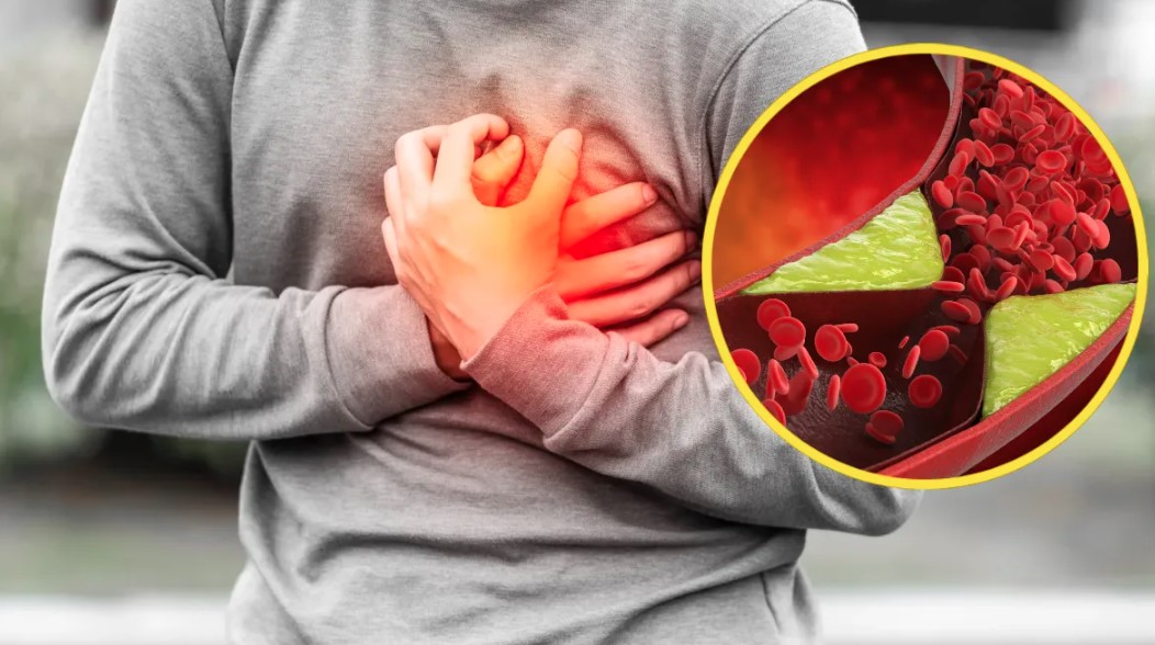 हाई कोलेस्ट्रॉल से बढ़ता है दिल की बीमारी का खतरा, जानिए कैसे करें बिना दवा के कंट्रोल